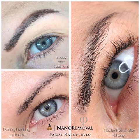 nanoremoval d&eacute;tatouage sans laser