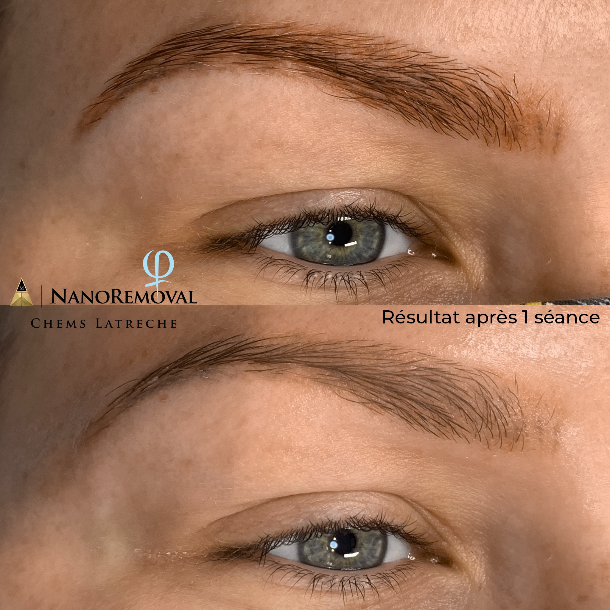 nanoremoval d&eacute;tatouage sans laser